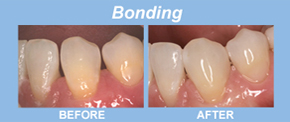 bonding, tooth replacement, tooth restoration, porcelain veneers, implants