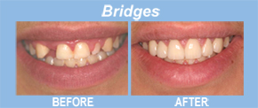 bridges, tooth replacement, tooth restoration, porcelain veneers, implants