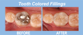 colored fillings, tooth replacement, tooth restoration, porcelain veneers, implants