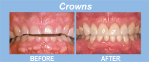 crowns, tooth replacement, tooth restoration, porcelain veneers, implants