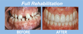 full rehab, implants, tooth replacement, tooth restoration, porcelain veneers, implants