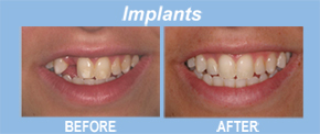 implants, tooth replacement, tooth restoration, porcelain veneers, implants