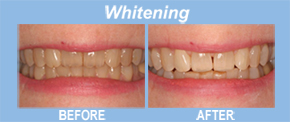 whitening, tooth replacement, tooth restoration, porcelain veneers, implants