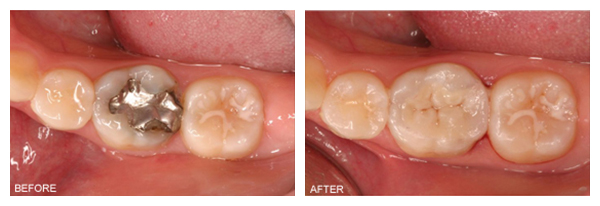 tooth-colored-fillings-final1