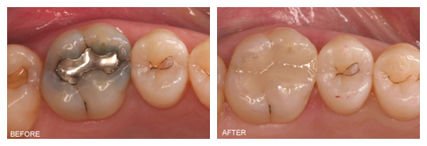 tooth-colored-fillings-final3