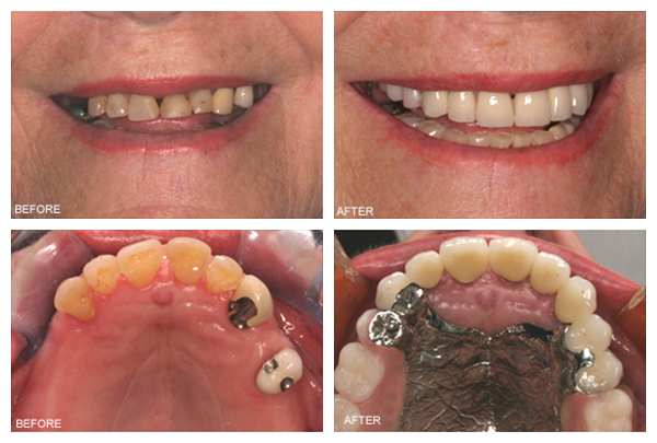 dentures-partials-final3