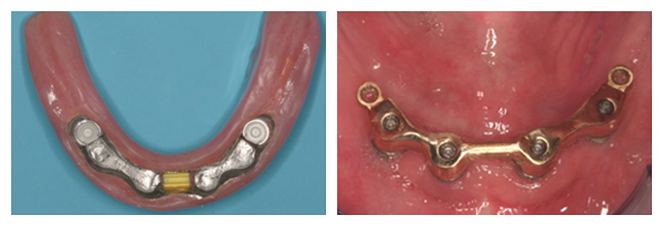 implant-dentures-final3