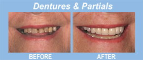 bridges, tooth replacement, tooth restoration, porcelain veneers, implants