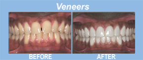 veneers, tooth replacement, tooth restoration, porcelain veneers, implants