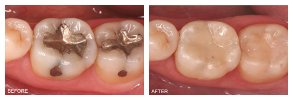 tooth-colored-fillings-final2