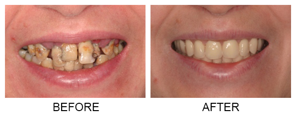 dentures-partials-final5