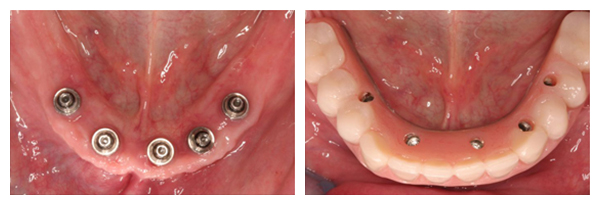 implant-dentures-final1