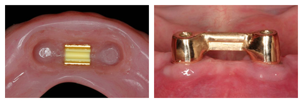 implant-dentures-final2