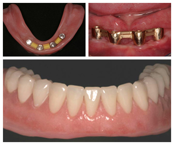 implant-dentures-final4