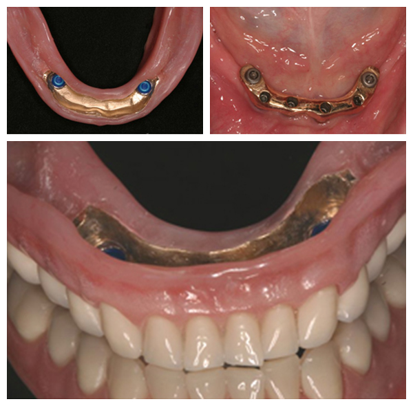 implant-dentures-final5