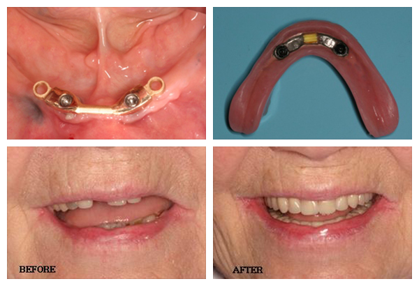 implant-dentures-final6