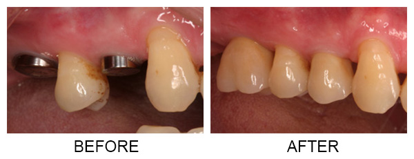 implants-final4